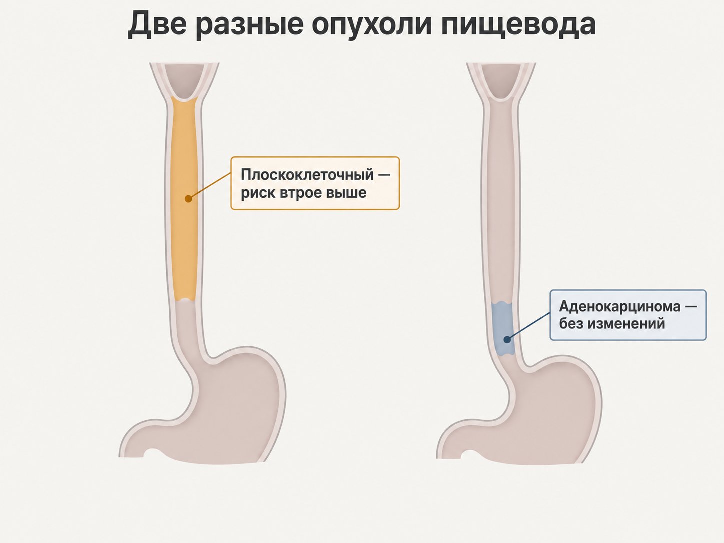 Два силуэта пищевода рядом, у верхнего подсвечена выстилка с пометкой «плоскоклеточный: риск втрое выше», у нижнего — железистая зона у желудка с пометкой «аденокарцинома: без изменений»